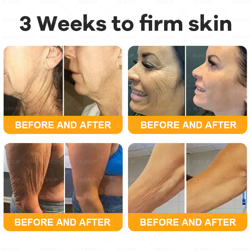 VLSVLS® Bee Venom Comprehensive Cream  🇨🇦🇨🇦LAST DAY 80% OFF🌟 (Sagging Skin, Fine Lines, Loss of Firmness, Flat Bust, Drooping Hips, and More)